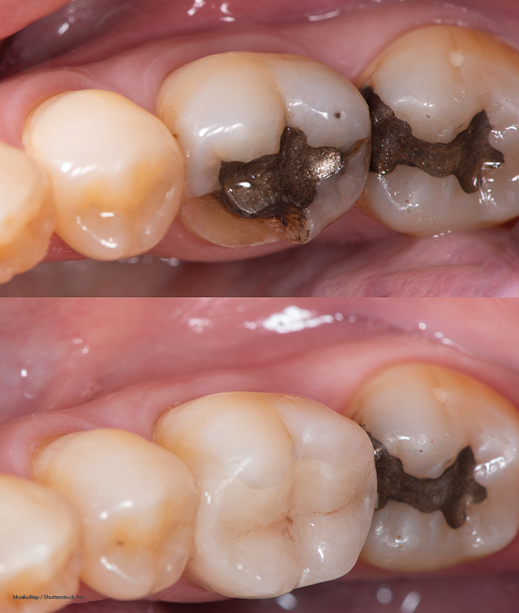 На фото сверху: запломбированные зубы, снизу — перелеченные с использованием керамических вкладок