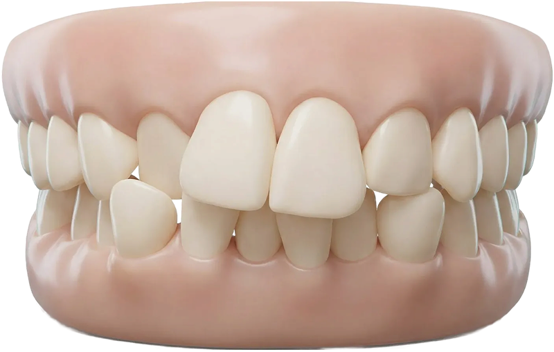 Скученность зубов