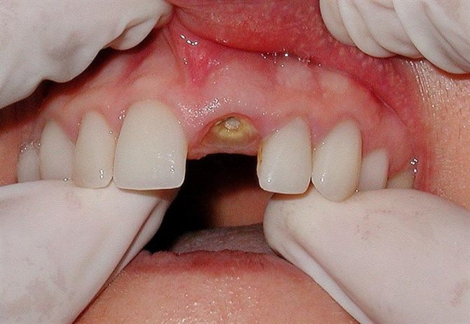 Alveolit posle udalenija zuba