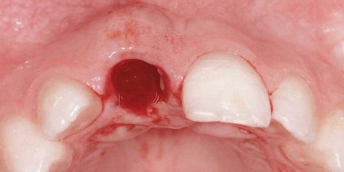 krovotechenie vospalenie desny posle udaleniya zuba