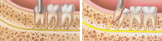 сколько дней заживает десна после удаления зуба у взрослого человека
