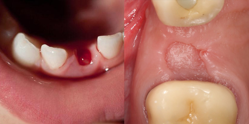 Как заживает десна после удаления зуба: этапы, сроки, возможные осложнения
