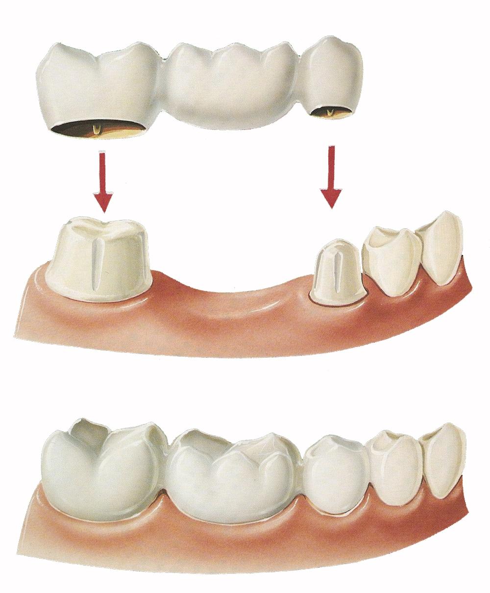 Стекловолоконные зубные протезы